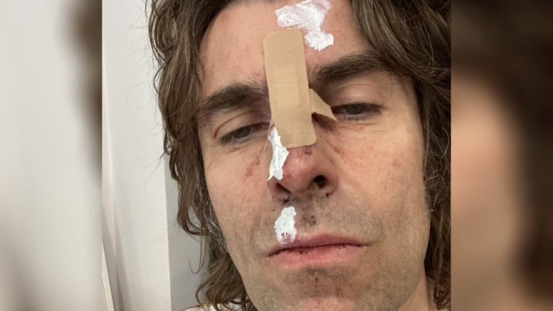 Liam Gallagher aparece com rosto machucado após acidente de helicóptero