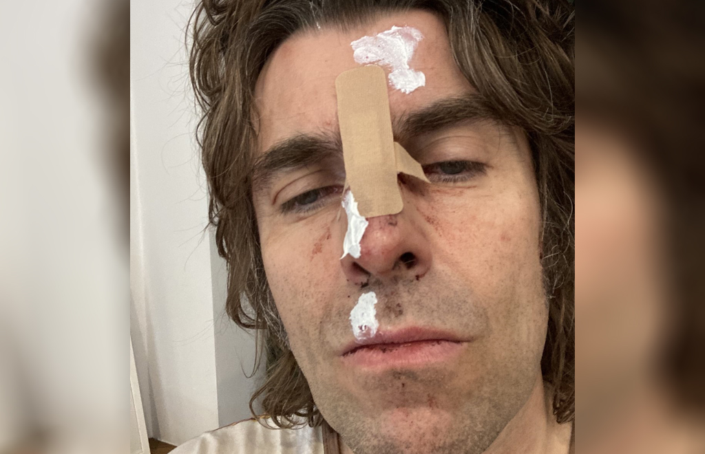 Liam Gallagher aparece com rosto machucado após acidente de helicóptero