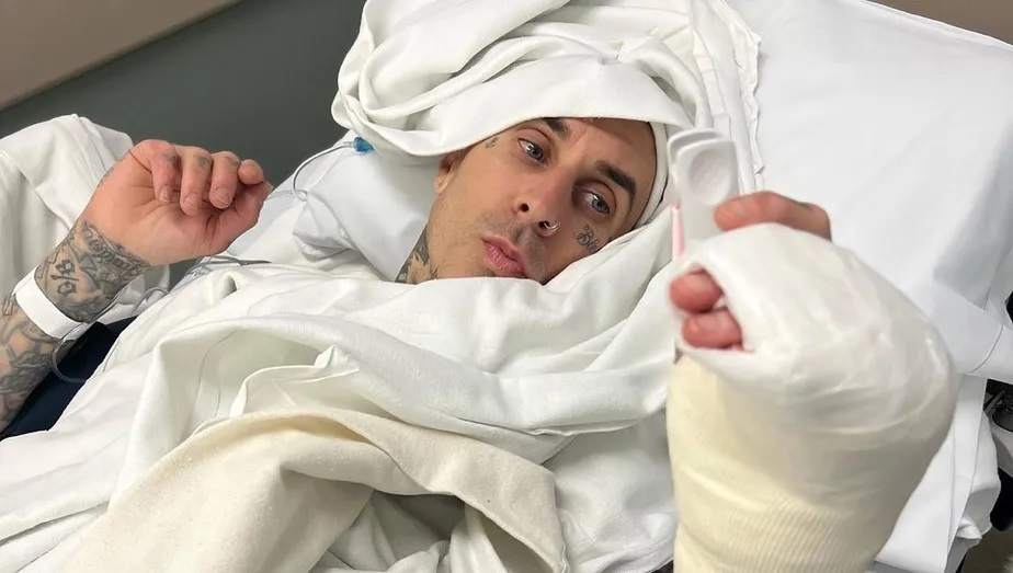 Travis Barker, do Blink-182, divulga imagem forte da cirurgia no dedo